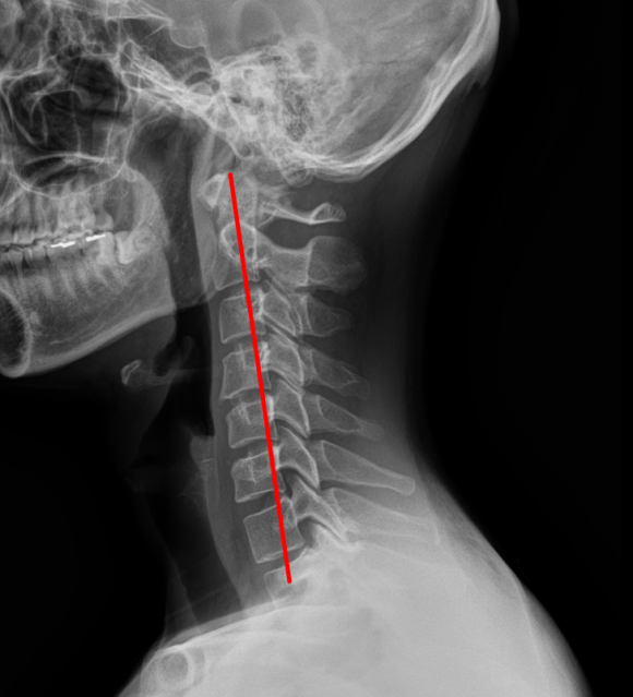 어깨 충돌증후군 & 회전근개파열