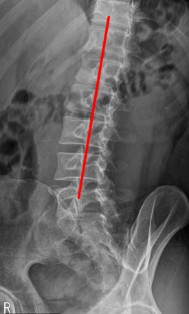 SLAP 파열 & 일자허리