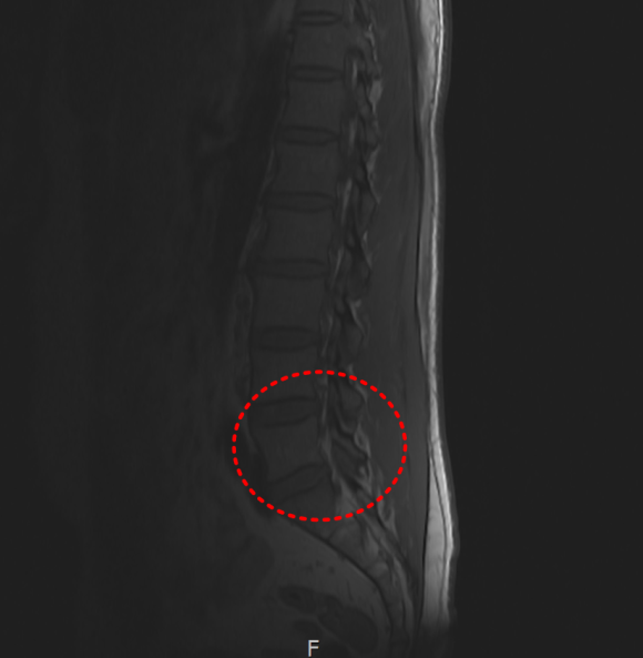 대퇴사두근 파열